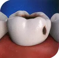 Что вам известно о зубном налёте и зубном камне?