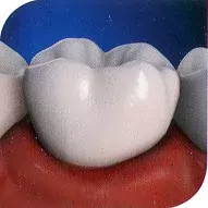 Что вам известно о зубном налёте и зубном камне?
